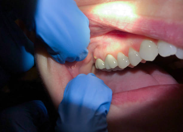Best Knocked-Out Tooth (Avulsed Tooth) Treatment in Spencerville, NM